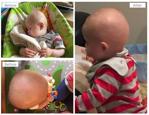 Treatment Of Baby Flat Head Syndrome Positional Plagiocephaly