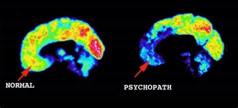 Brain Scan Of A Normal Orbital Cortex And A Psychopath Orbital Cortex
