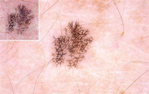 Dermoscopy Of Melanocytic Hyperplasias Subpatterns Of Lentigines Ink