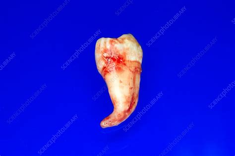 Extracted Wisdom Tooth Stock Image C0333480 Science Photo Library