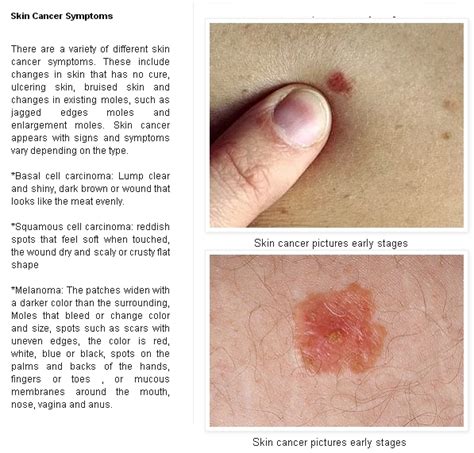 Early Signs Of Skin Cancer Pictures 15 Photos Images Illnessee Com