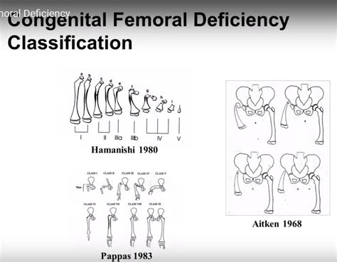 Congenital Femoral Deficiency —