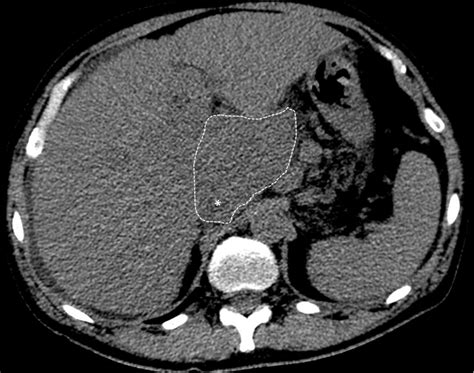 Caudate Lobe Hypertrophy Non Enhanced Axial Ct Scan Image Of The