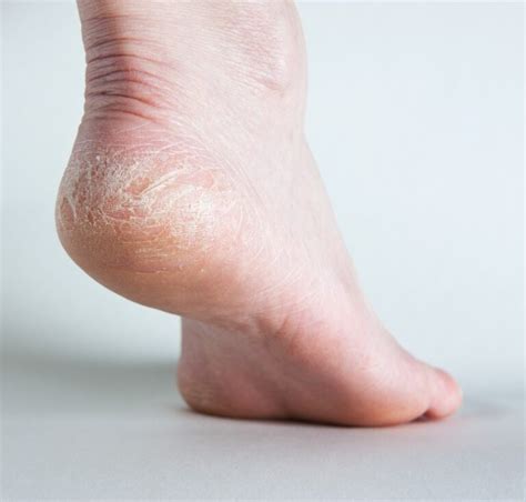 Sores On Bottom Of Feet Causes Symptoms And Treatments American Celiac