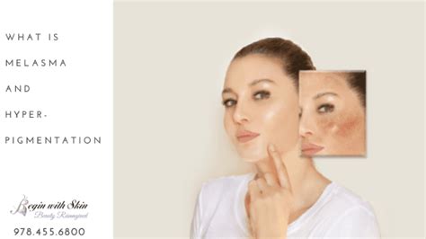 Melasma And Hyperpigmentation What Is A Girl To Do Begin With Skin