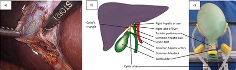 Laparoscopic Cholecystectomy Lc Anatomy And The Proposed Phantom A