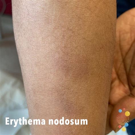 Erythema Nodosum Arms
