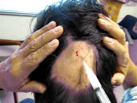 However, in the first weeks after. alopecia areata injections - YouTube
