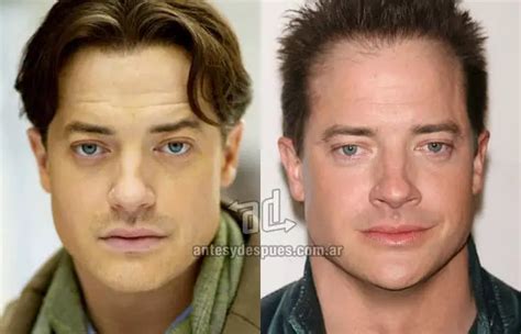 Brendan Fraser Before Plastic Surgery