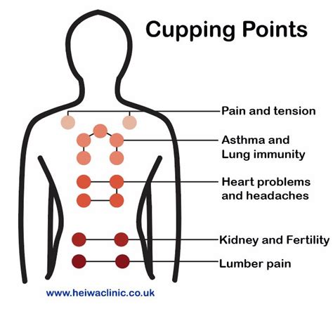 Cupping Therapy For Better Health