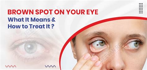 Brown Spot On Your Eye What It Means And How To Treat It