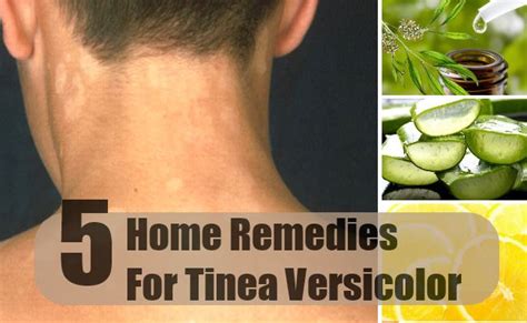 Pityriasis Versicolor Causes Symptoms And Treatment With Tea Tree Oil