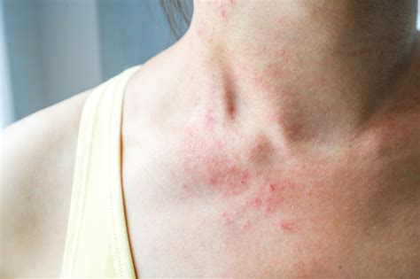 Grzybica skóry gładkiej objawy przyczyny leczenie i zapobieganie nawrotom choroby ZnamLek pl