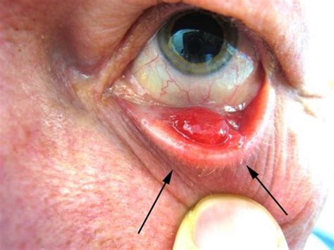 Cyst On Eyelid Hot Sex Picture
