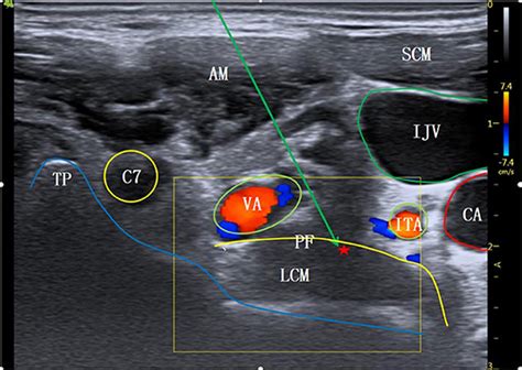 Ultrasound Guided Stellate Ganglion Block