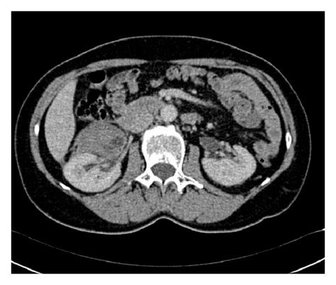 Ct Scan Revealed A Right Perirenal Hematoma After The Rupture Of The