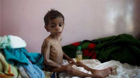 أنقذوا الأطفال المجاعة تتهدد مليون طفل إضافي في اليمن