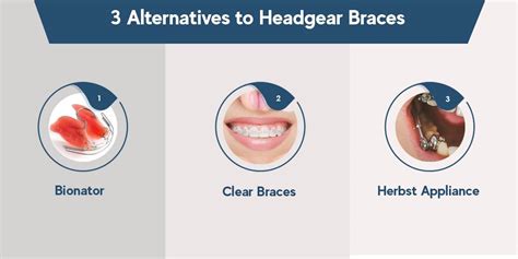 Guide To Headgear Braces Pros Cons Alternatives 2023