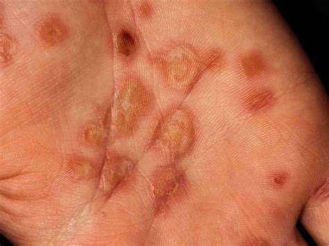 Toxic Epidermal Necrolysis Causes Symptoms Treatment