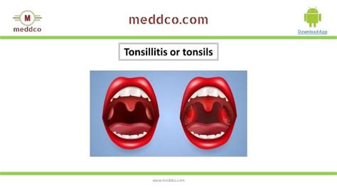 Tonsillitis Typescausessymptomsdiagnosisprevention And Treatment