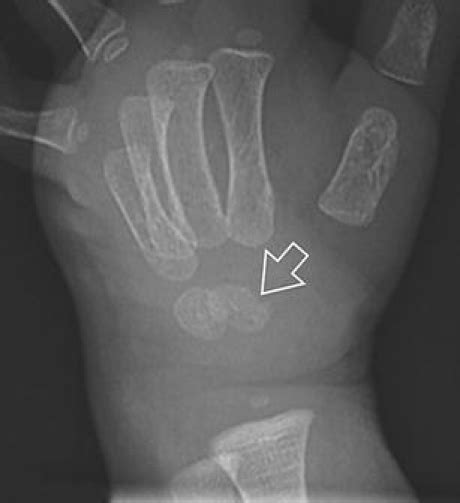 Capitate Fracture On Conventional X Ray Open I