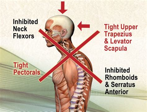 Does Weak Posture Really Matter Erik Dalton Blog