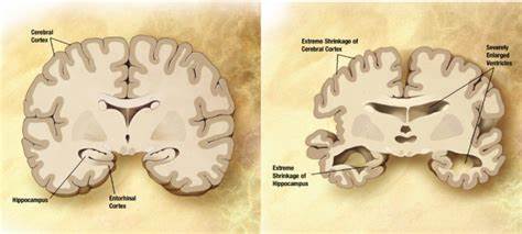 Cerebrum cholesterol attached to Alzheimer's infection