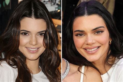Inside The Evolution Of Kendall Jenner S Lips Over The Years As The Model Was Accused Of