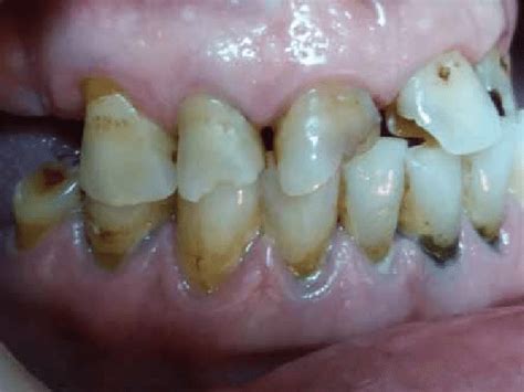 Abfraction is the loss of tooth structure from flexural forces. ABFRACTION LESIONS PDF