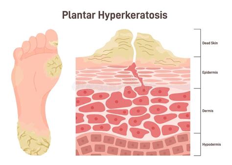 Plantar Hyperkeratosis Feet Corns And Calluses Medical Condition