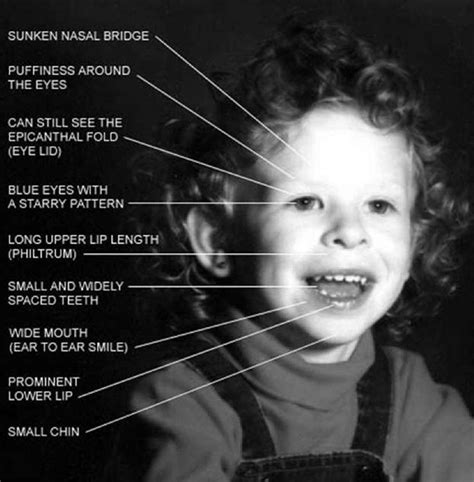 Williams Syndrome Pictures Causes Symptoms Treatment Life Expectancy Diseases Pictures