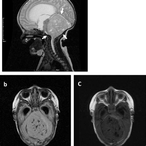 Radiological Features Of Common Neonatal Brain Tumors 21 22