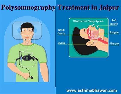 Polysomnography Treatment In Jaipur Photograph By Asthma Bhawan Fine