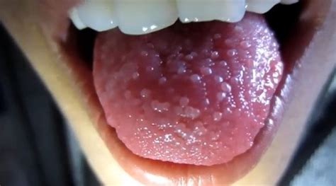 Back Of Throat White Bumps On Tongue