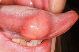 Allergic Reaction Swollen Tongue Treatment Images