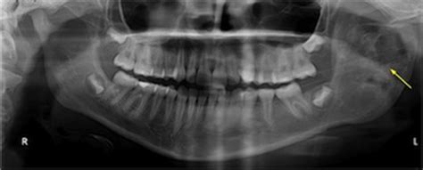 Aneurysmal Bone Cyst Of The Mandible Affecting The Articular Condyle A