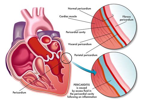 La péricardite est une inflammation du péricarde, le mince sac protecteur à double membrane qui enveloppe le cœur. Pericardite: sintomi, cause e cura