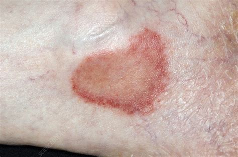 Ringworm Fungal Infection Stock Image C0167254 Science Photo Library