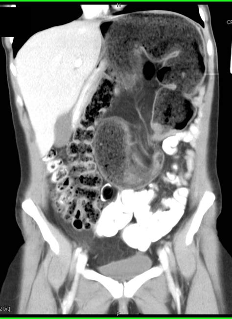 Large Amount Of Stool In Colon On Ct Scan