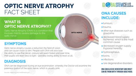 Patients Improvements After Treatment For Optic Nerve Atrophy Gsc