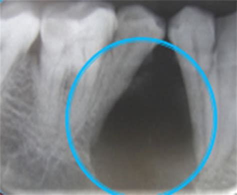 Lateral Radicular Cyst