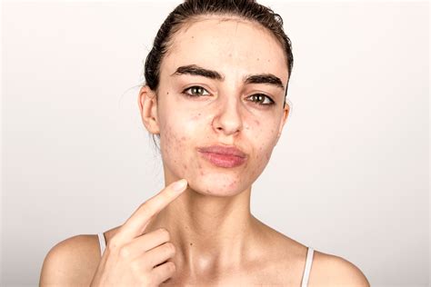 Acne Breakouts Around Mouth Causes Treatments And More