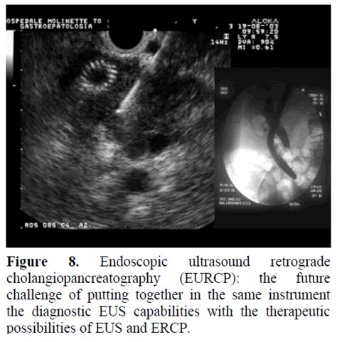 Pancreatic Cancer Imaging The New Role Of Endoscopic Ultrasound