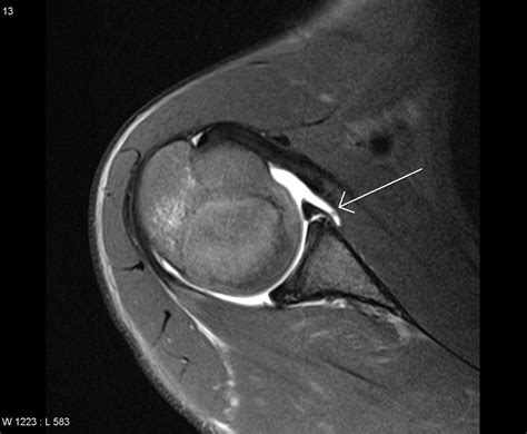 Traumatic injury to the shoulder or overuse of the shoulder by excessive throwing or weightlifting can cause a labral tear. Mri Arthrogram, Glenoid Labral Tear | Medical imaging ...