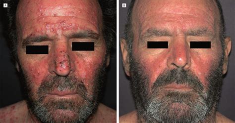 Efficacy Of Treatment With Tetracyclines To Prevent Acneiform Eruption