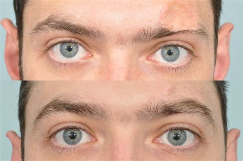 Eyebrow Transplantation Is A Surgical Procedure Intended To Permanently