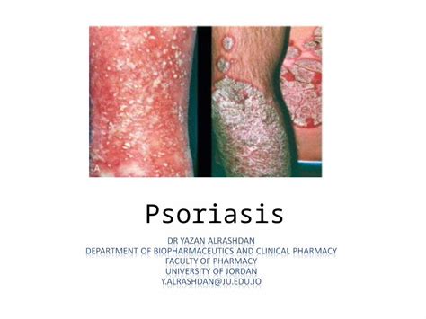 Ppt Psoriasis Definition And Facts Epidemiology Classification Signs