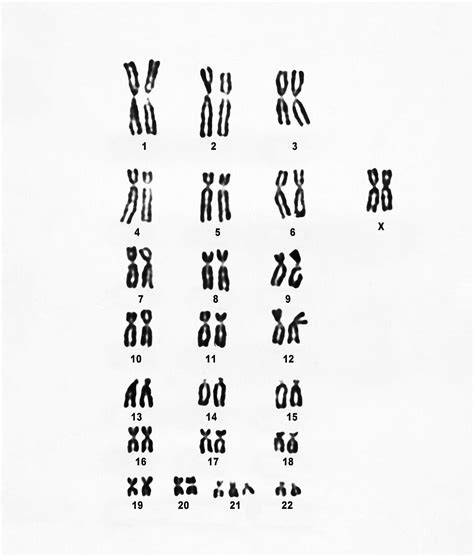 Female Karyotype Showing Downs Syndrome Bild Kaufen 12026070 Science Photo Library