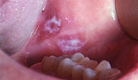 It will start small and grow significantly larger if you dont have it surgically removed. White Sores in Mouth, Causes, Roof, Baby, Open Sore, Bumps, Throat, Painful, Red, Gum, Pictures