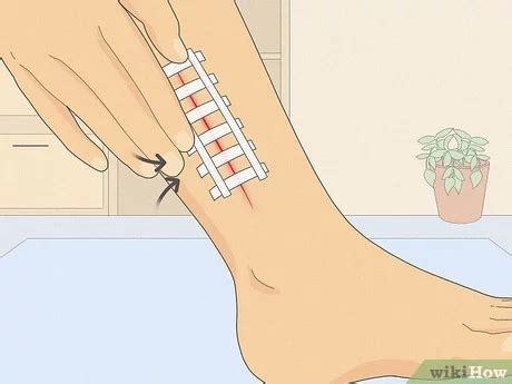 The Proper Way To Remove Steri Strips E Phlebotomy Training
